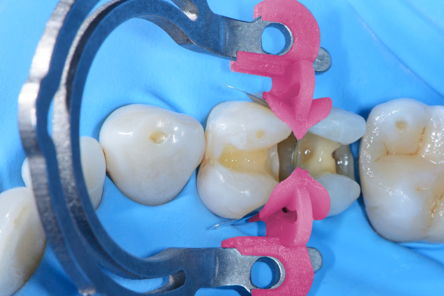 Polydentia MyTines Prime Refills Qty 6 Pairs