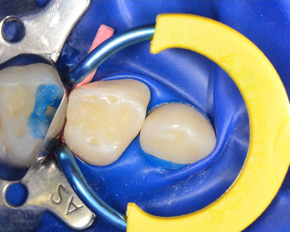 Polydentia myJunior Kit - Pediatric Dentistry Sectional Matrix Kit